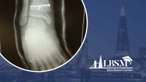 Growth plate injuries in adolescents